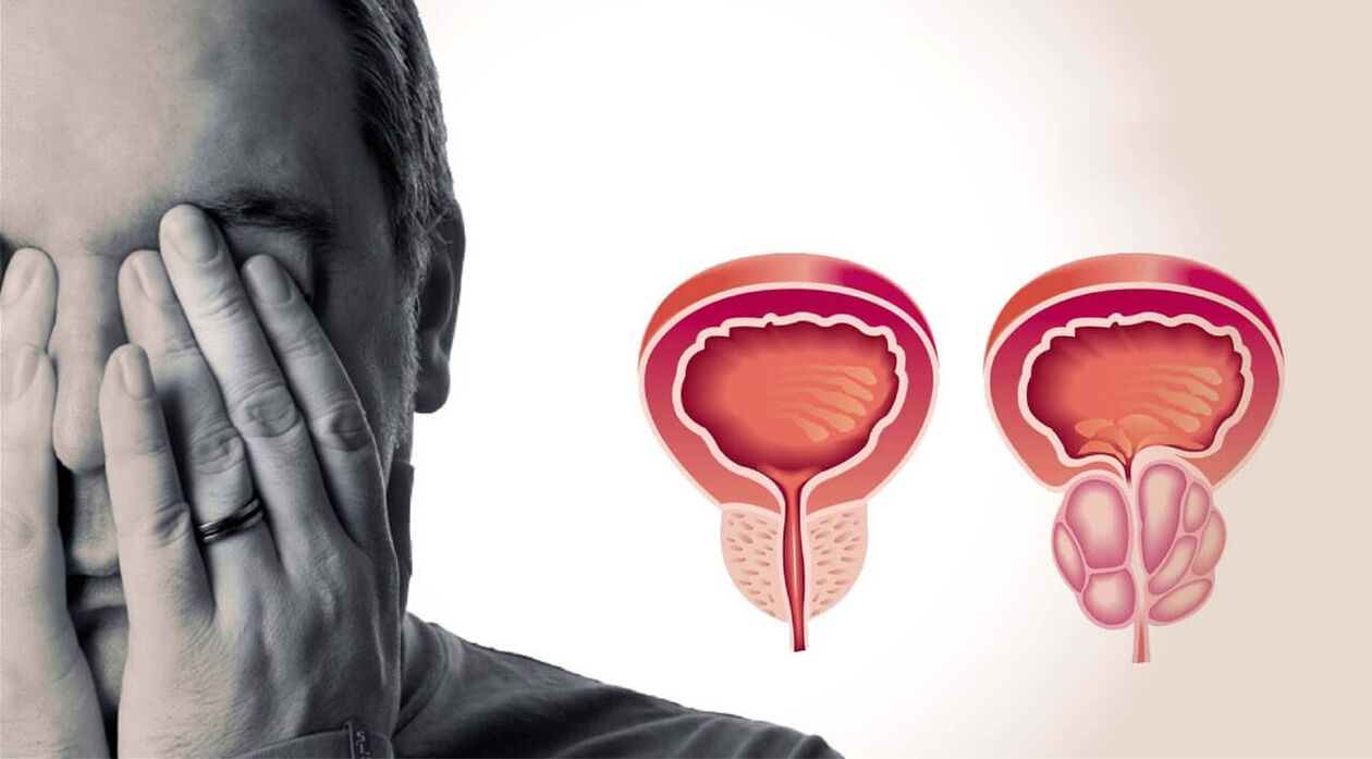Prostată sănătoasă și dureroasă la bărbați