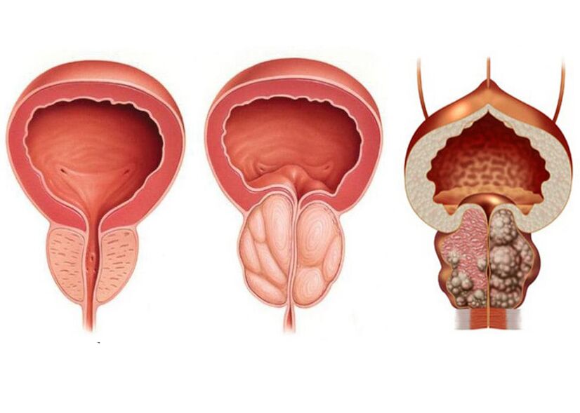 etape de prostatită și nevoia de a utiliza pe deplin prostavit